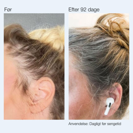 foer efter anti hair loss kvinde