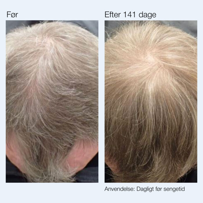 foer efter anti hair loss mand