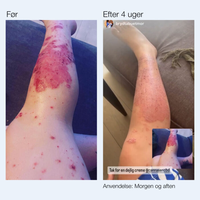 foer efter psoriasis gel 2