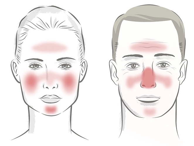 Rosacea i ansigtet